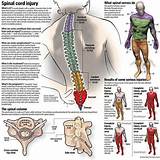 Images of Side Effects Of Cervical Laminectomy