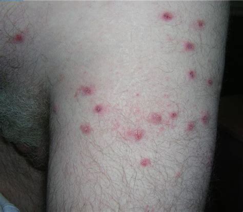 Dermdx Itchy Rash On Shoulders Trunk Clinical Advisor