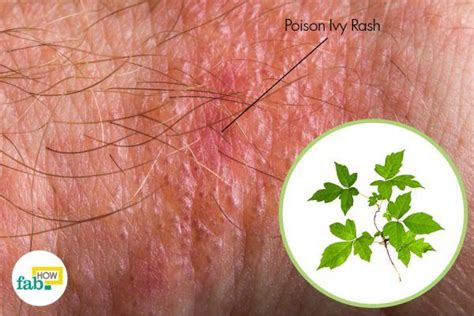 How To Get Rid Of Poison Ivy Rash In One Day Fab How