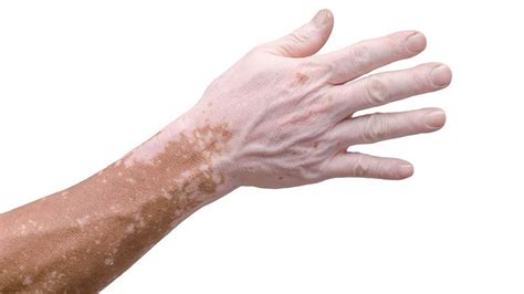 Effective Vitiligo Surgery In Pitampura For Beautiful Skin
