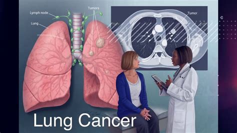Lung Cancer Low Dose Ct Scan For Early Detection Youtube