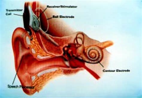 Schematic View Of Cochlear Implant In Situ Download Scientific Diagram