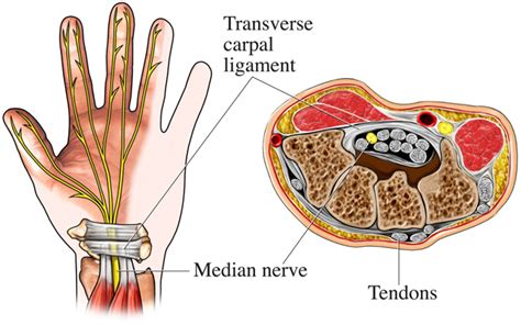 Carpal Tunnel Ultrasound And Injection Insideradiology