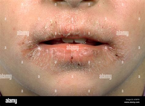 Lip Licking Eczema Stock Photo Royalty Free Image 11761414 Alamy