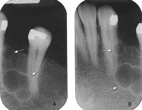 Multifocal Lateral Periodontal Cysts A Report Of 4 Cases And Review Of