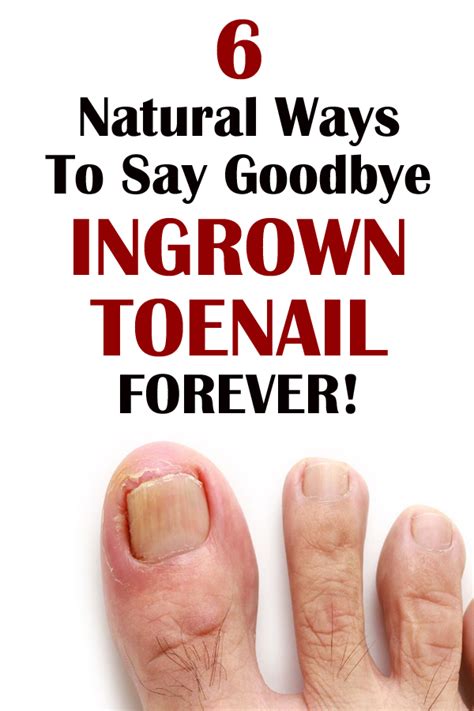 Treat Your Ingrown Toenail With These 6 Natural And Homemade Remedies