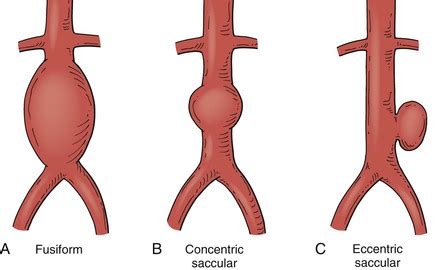 Arterial Aneurysms Thoracic Key