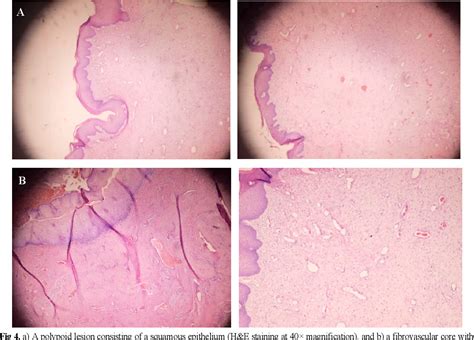 Figure 1 From An Unusual Presentation Of Giant Fibroepithelial Polyp Of