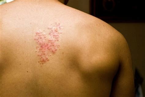 Which Types Of Doctors Can Help Treat Shingles An Tâm