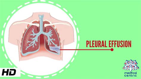 Pleural Effusion Causes Signs And Symptoms Diagnosis And Treatment