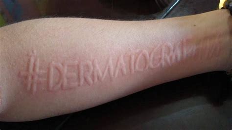 Writing On The Skin Dermatographism Medizzy