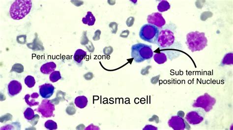 Plasma Cell In Lymph Node Cytology Youtube