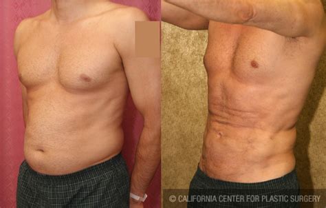 Patient 5646 Male Liposuction Abdomen Before And After Photos Beverly