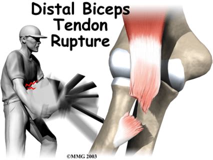 Distal Biceps Tendon Reconstruction With Tendoachilles Allograft A My XXX Hot Girl