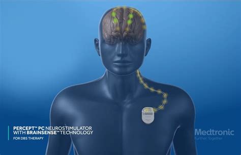 Innovative Deep Brain Stimulation Device Reads Brain Signals Allowing