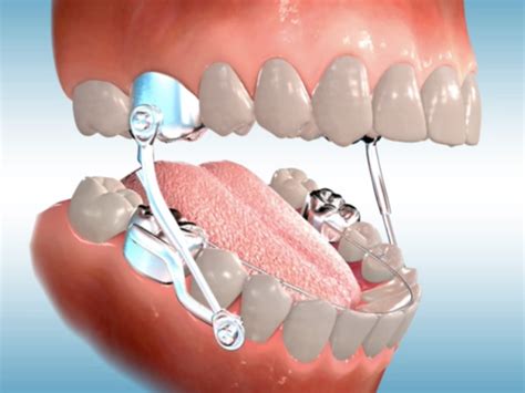 It all starts with a detailed, meticulous dental exam where all areas of the. Orthodontic Appliances, Functional