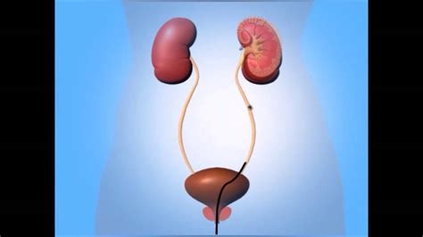 Ureteroscopy Kidney Stone Treatment Hyderabad Best Urologist And