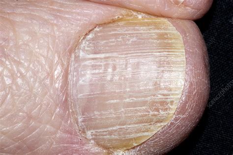 Psoriasis Of A Nail Stock Image M2400559 Science Photo Library