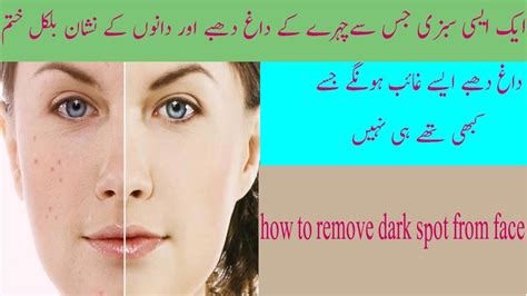 How To Remove The Acne Scars I Remove Dark Spots Black Spots And Acne