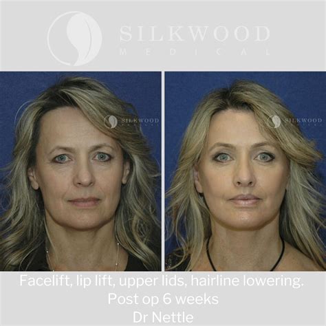 My Patient Achieved An Incredible Transformationf She Achieved This With A Facelift Lip Lift