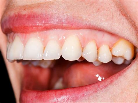 How To Stop Blood From Teeth Gums Teethwalls