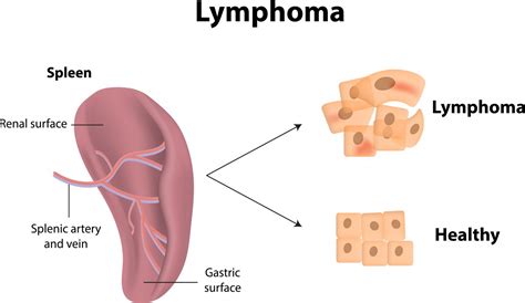 Types Of Lymphoma What You Need To Know