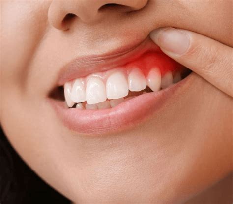 Gum Disease Symptoms Peakview Dentistry Periodontal Disease Stages