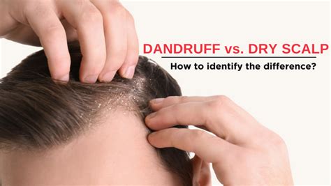 Dandruff Vs Dry Scalp How To Identify The Difference Irestore