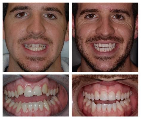 How To Fix Crooked Teeth Without Braces Or Invisalign Reverasite
