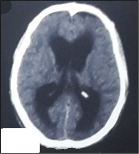 Postoperative Ct Brain Axial View Dilated Ventricles Suggestive Of