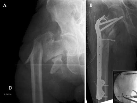 Past And Present Of The Use Of Cerclage Wires In Orthopedics Springerlink