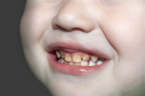 Why Are My Childs Teeth Yellow While Coming In Pediatric Dentistry
