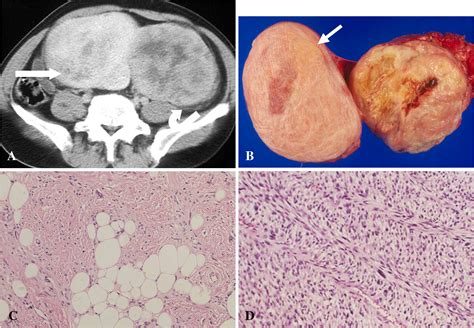 Dedifferentiated Liposarcoma Of Retroperitoneum Spectrum Of Imaging