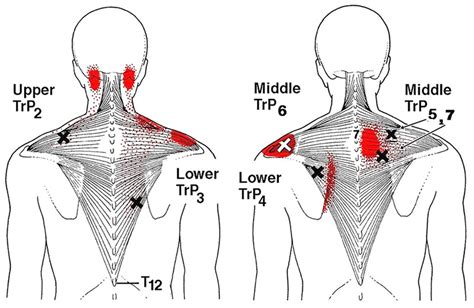 Trigger Point Injections Tim Manahans Osteopathic Services