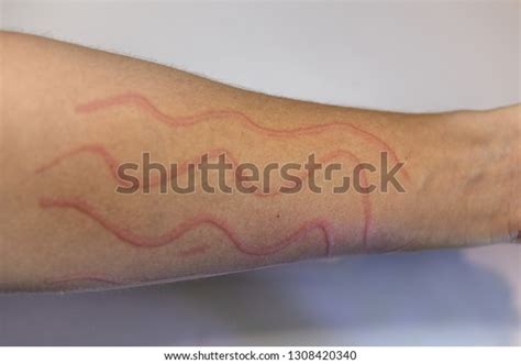 Dermatographic Urticaria Known Dermographism Dermatographism Skin Foto