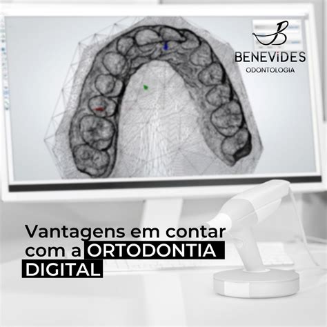 Anteriormente Explicamos O Que é A Ortodontia Digital Que Pode Ser Utilizada No Planejamento Do