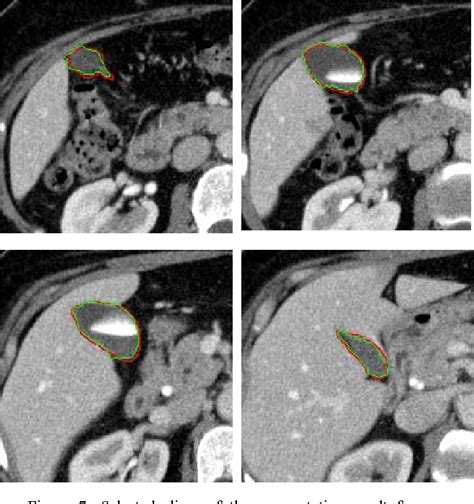 Segmentation Of Gallbladder From Ct Images For A Surgical Training