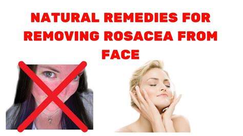Natural Remedies For Removing Rosacea From Face Youtube
