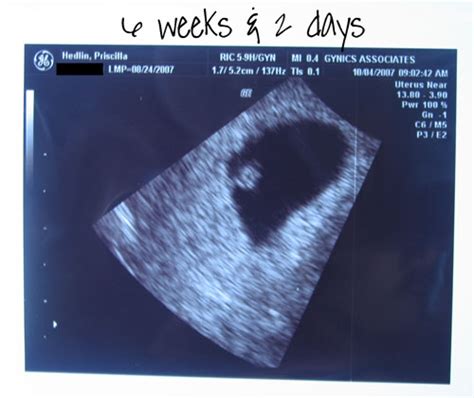 6 Weeks 2 Days Pregnant Baby Viewer