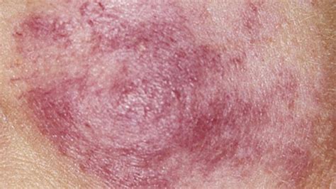 Systemic Lupus Erythematosus Causes Symptoms And Treatment