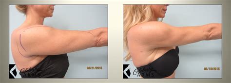 Arms Celebrity Arms Lipo Before After Photos Art Lipo