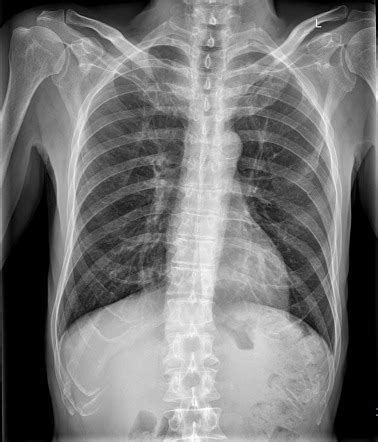Rib Fracture Radiology Case Radiopaedia Org