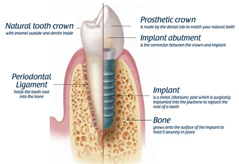 Dental Implant Infographic 1 Pacific Oral Surgery