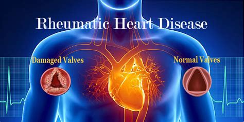 Rheumatic Heart Disease And Its Symptoms In 2020