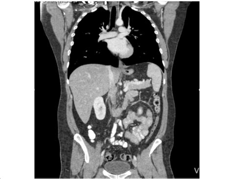 Ct Of The Chest Abdomen And Pelvis Performed In The Postoperative