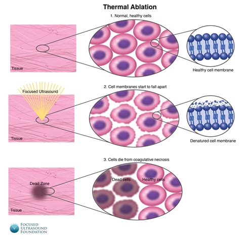 Thermal Ablation Focused Ultrasound Foundation