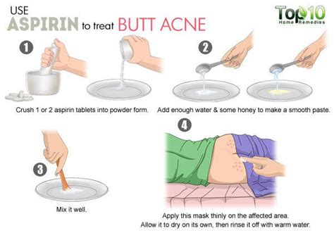 How To Treat Butt Acne Naturally Page 3 Of 3 Top 10 Home Remedies