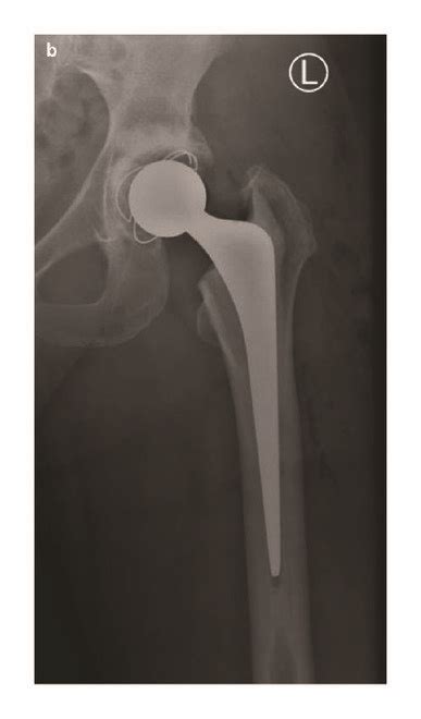 A Uncemented Total Hip Replacement Thr With A Ceramic On Ceramic