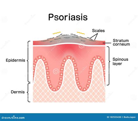 Psoriasis Skin Disease On Cartoon Vector 152300181