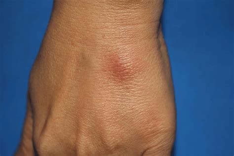 Erythema Nodosum At The Dorsum Of The Left Hand In A Patient Diagnosed